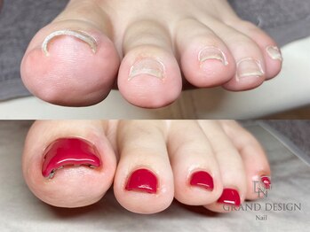 グランドデザイン 穂積店(GRAND DESIGN)/NEW★巻き爪矯正+ワンカラー