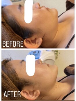 リノア(LINORE)/小顔リフト6回