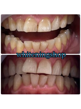 ホワイトニングショップ 日進店/Before After日進ホワイトニング