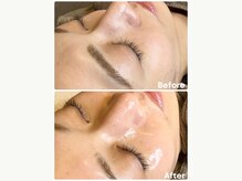 アンフェム(Anfem)/水光ピーリング