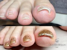 グランドデザイン 穂積店(GRAND DESIGN)/NEW★巻き爪矯正+ワンカラー