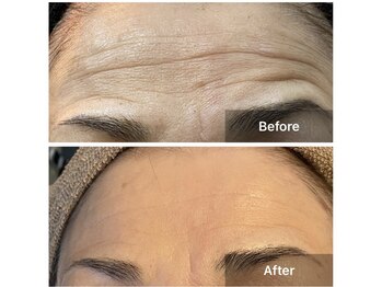 リノリー(rinory)/気になるおでこが変わりました