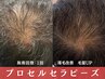 【頭皮】プロセル頭皮改善トリートメント驚きのスピード改善で毛量UP！！