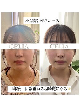 セリア(CELIA)/小顔/小顔矯正/面長/エラ張り