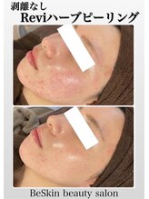 ビースキン 藤沢店(BeSkin)/剥離なしReviハーブピーリング
