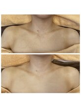 シェービングアンドエステ ブランピュア(Blanc pur)/デコルテシェービング