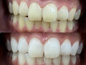 アーティ(aaty)/セルフホワイトニング/白い歯