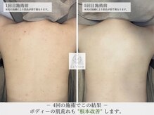 ダイヤモンドハーブピーリング[/シミケア/ニキビケア/毛穴]