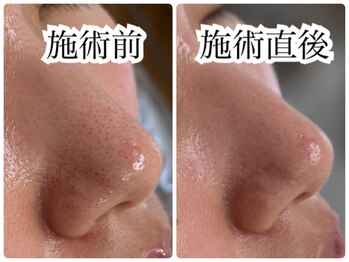 シェミー(CHEZ MEE)/【即実感】毛穴洗浄＆イオン導入