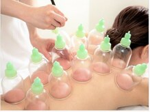 吸い玉（カッピング）