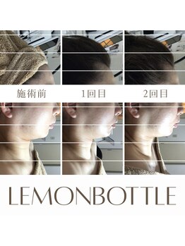 ベイジョ デ アンジョ(Beijo de anjo)/レモンボトル