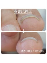 ピピ(PiPi)/【巻き爪補正】