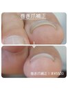 【巻き爪補正】