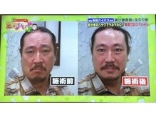 トムズ(Tom’s)/笑い飯西田幸治さん施術前後！！