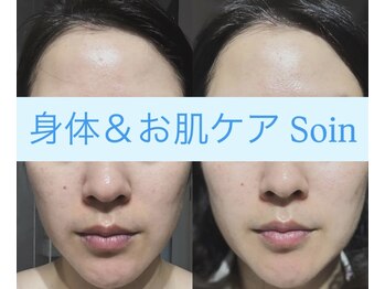 ソアン(Soin)/炭酸パック