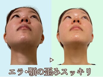 ナチュラルビューティーフェイス 横浜(NBF)/ほほ骨・エラ張り矯正