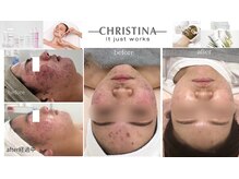 ベルフィーヌボーテ(BELFINE beaute)の雰囲気(CHRISTINAでニキビケア症例多数!!)