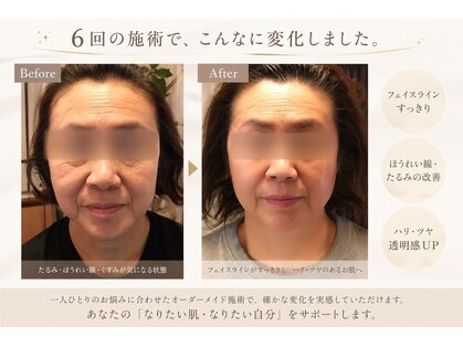ビプレ(BIPURE)の写真