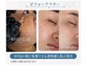 韓国発最新シミケア　もうコンシーラーで隠さない　お顔施術し放題３０分