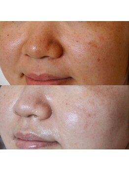 トラット エステアンドアイズ(tratto)/30代前半　お客様症例写真