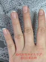 桃の木 吉祥寺店/３０代女性／２回目施術前