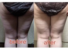 カドゥルエクラ(Cuddleclat)/BODY　Before→After