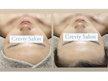 クレヴィー(Creviy)/最先端の最強細胞美容成分コース