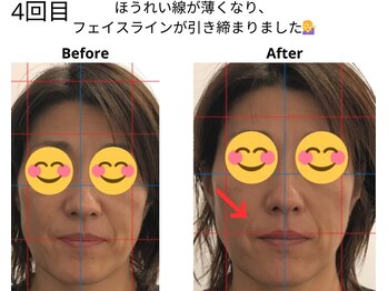 ベル/50代の方の小顔Before After
