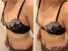 リール 新宿店(RIRE)/30代前半　バストアップ症例