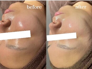 イリゼ(iriser)/ハーブピーリングBeforeAfter