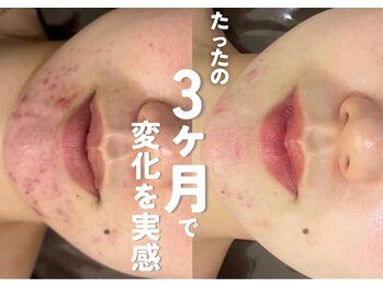 ホワイトアクア 鹿児島店(WHITE AQUA)/ハーブピーリング/ニキビケア