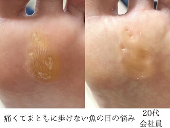 足裏タコ魚の目ケア