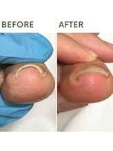 クオッカ(Quokka)/巻き爪ケア