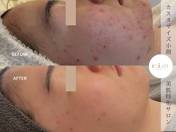 エイム(e.i.m)/２0代：ニキビ/赤み