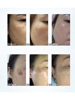 Kino Beauty Salon二子玉川店 ローマピンク/ホワイトラボ/脂肪冷却/シミ/メラニンケア/ホワイトラボ