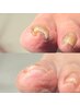 【人気No.1】長年の悩みを徹底解決！巻き爪ケア（両足）120分￥13,000