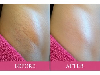 マロズワックス ブラジリアンワックスアンドスパ(Maro's Wax Brazilianwax Spa)/ワキWax★　　Before After