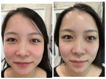 アンベリール(EMBELLIR)/毛穴のお悩みの方