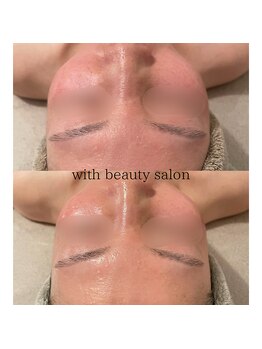 ウィズ(with)/REVIハーブピーリング