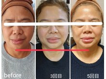 エム(M)/整体小顔矯正 &nbsp;ハーブピーリング