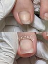 巻き爪直して