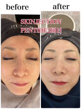 シェービングアンドエステティックエミュ (shaving & estetic emu)/スキンジェクションプロ　使用後