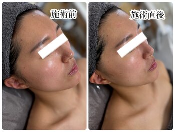 シェミー(CHEZ MEE)/小顔/フェイスライン/リフトUP 