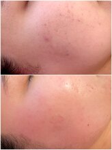 福岡美人工房 アロマムーン/ハーブピーリング施術5日後の肌