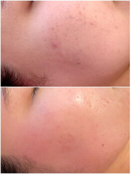 福岡美人工房 アロマムーン/ハーブピーリング施術5日後の肌