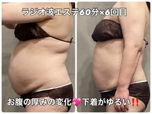 リエル(RIEL)/ラジオ波エステ