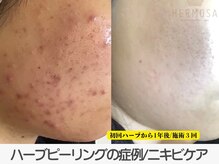 ラ コケット(La Coquette)/エルモサ/ハーブピーリング