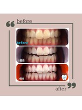 キラット 高知中万々店(Kiratt)/【クリスタルホワイトニング】