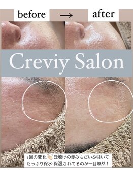 クレヴィー(Creviy)/日焼けによるダメージにも♪