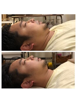 フォルム ボディアンドフェイス 恵比寿(Forme)/もたついたフェイスライン改善